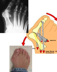  Hallux Valgus