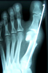 ortho_fuss_valgus_5.jpg